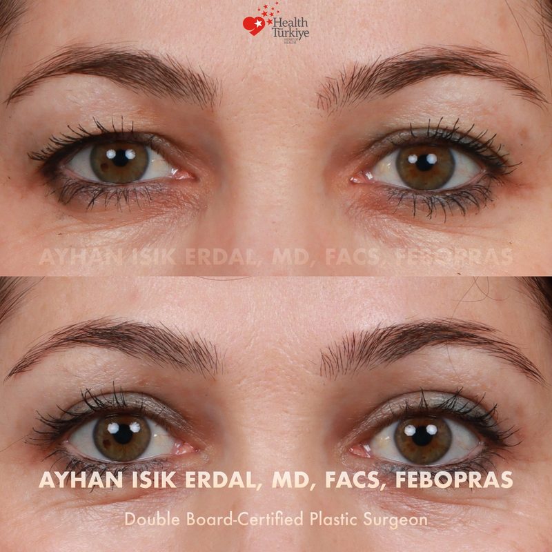 Upper blepharoplasty before and after - eyes close-up