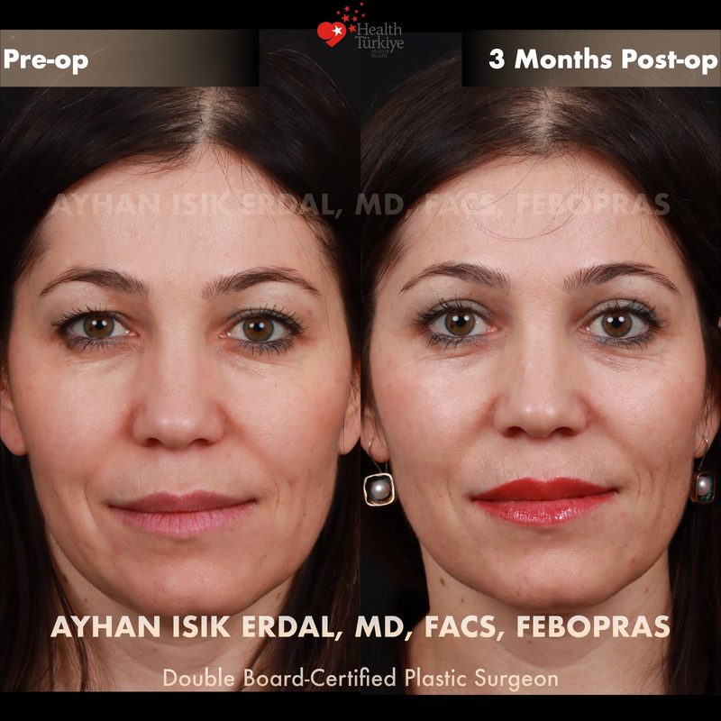 Upper blepharoplasty before and after - front view
