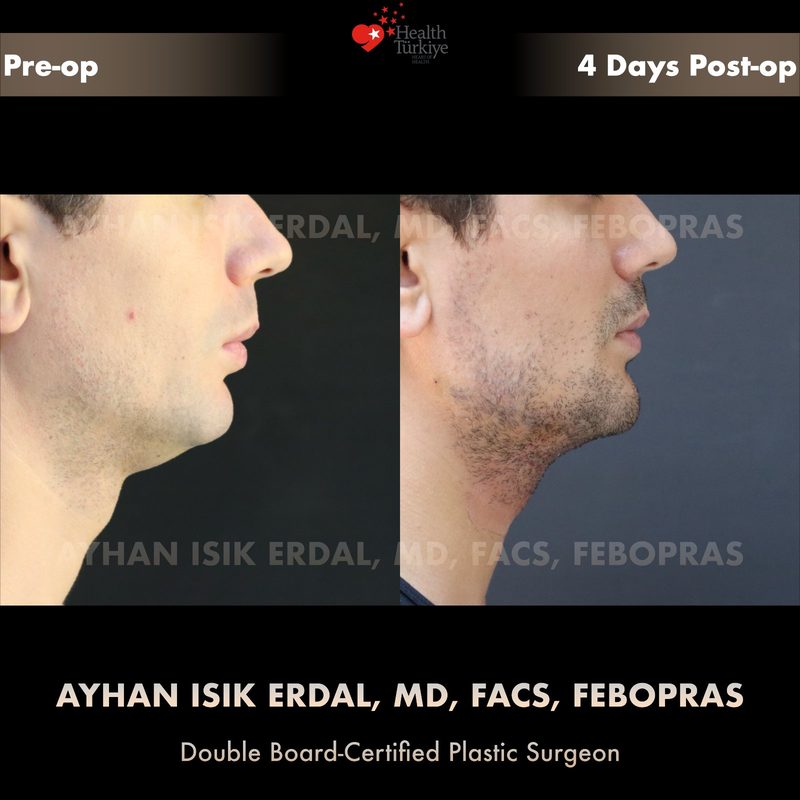 Chin liposuction before and after - side view