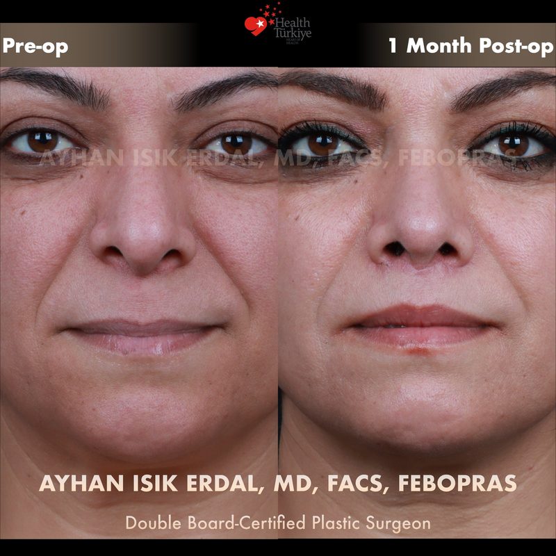 Lip lift before and after - close-up