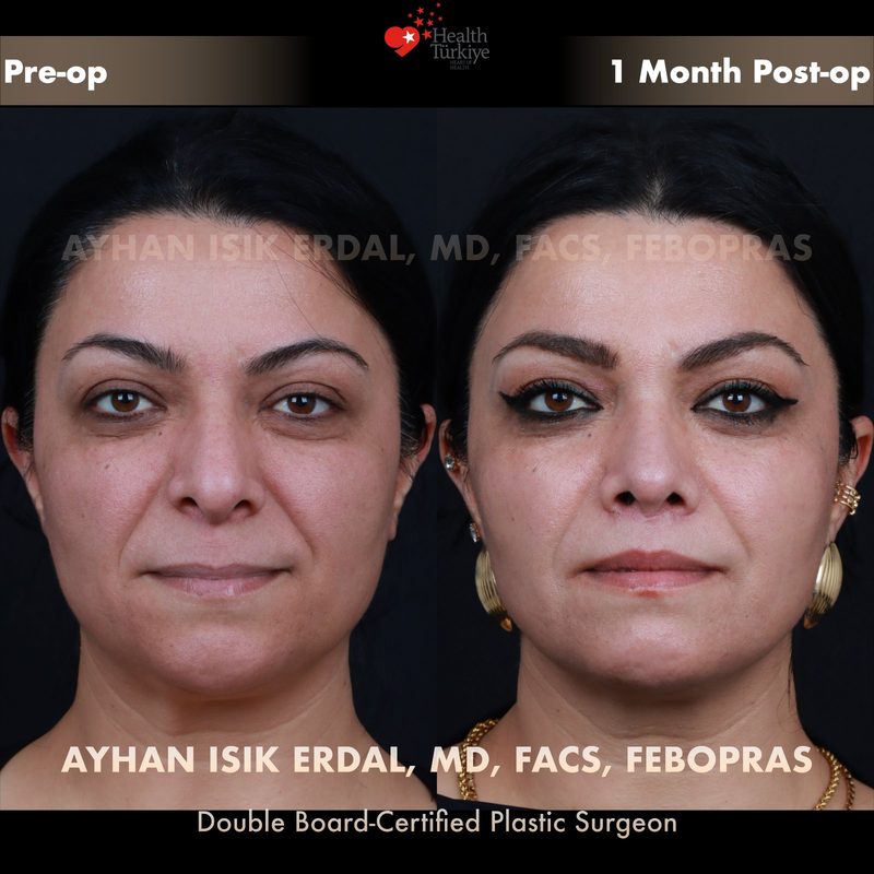 Lip lift before and after - front view