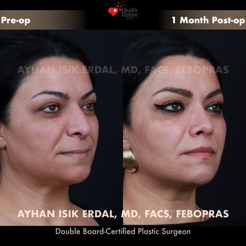 Lip lift before and after - oblique view
