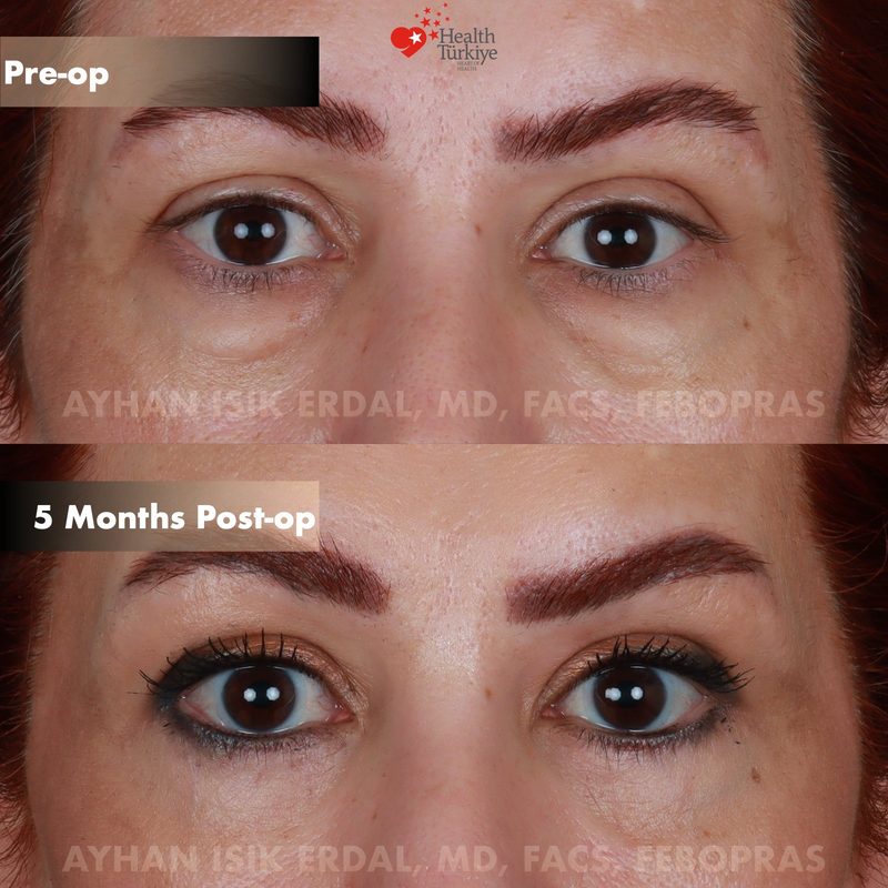 Lower blepharoplasty before and after - eyes close-up