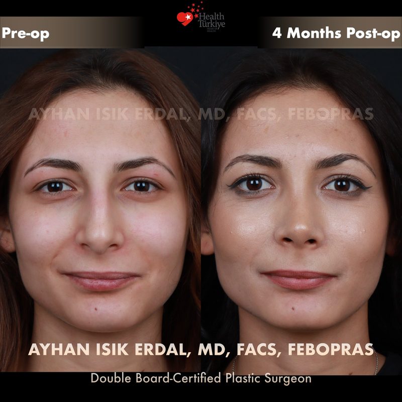 Rhinoplasty before and after - front view