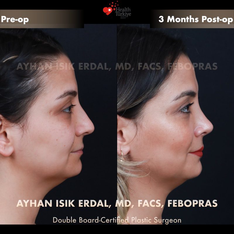 Rhinoplasty before and after - side view