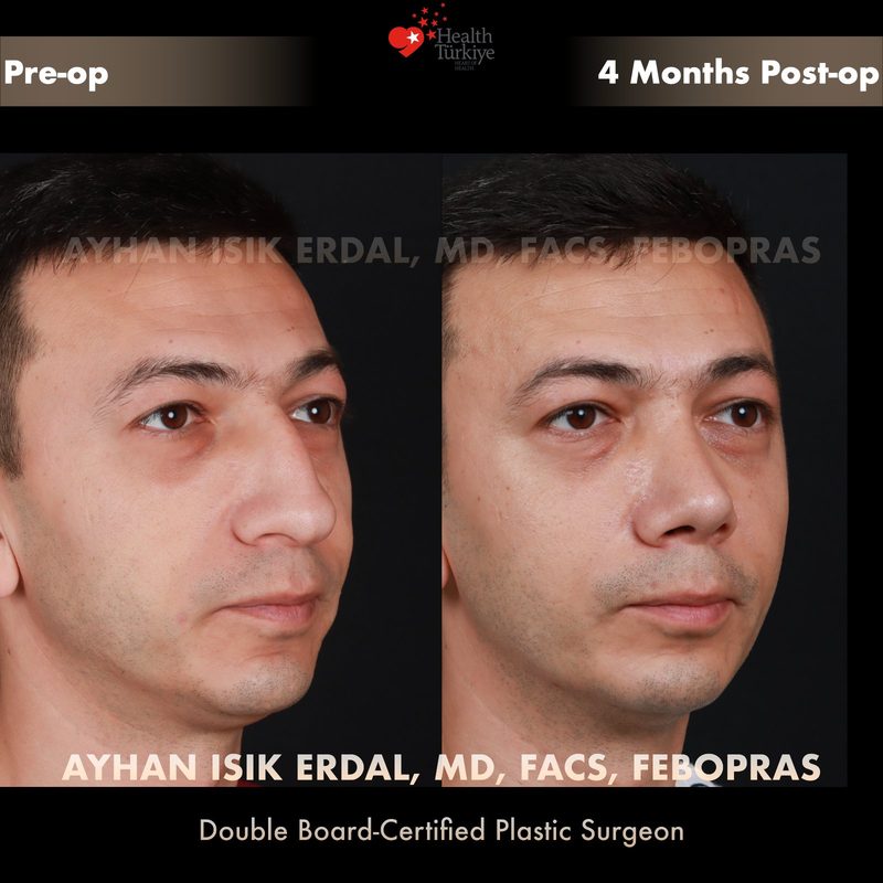 Rhinoplasty before and after