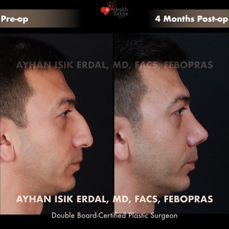 Rhinoplasty before and after