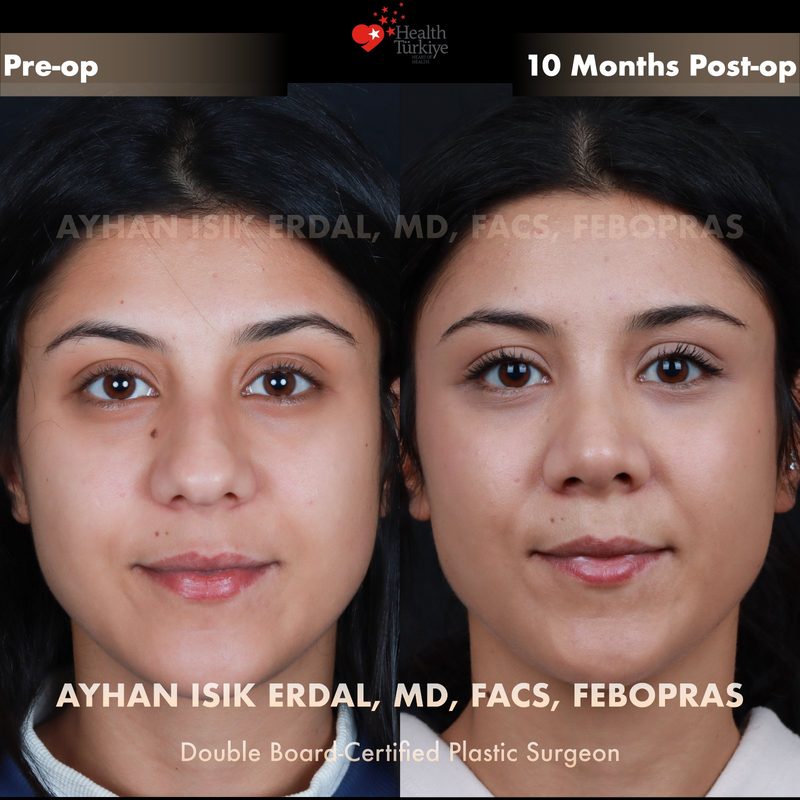 Rhinoplasty before and after