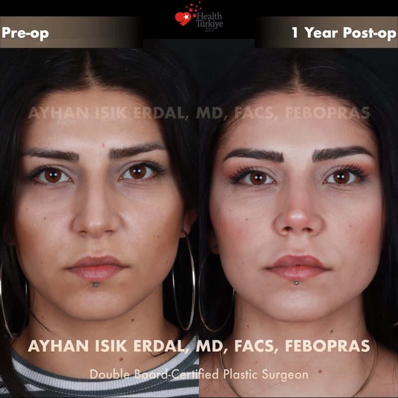 Rhinoplasty before and after