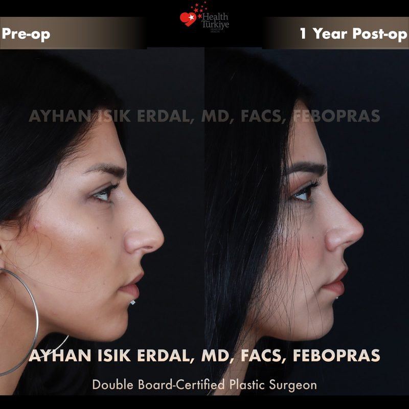 Rhinoplasty before and after