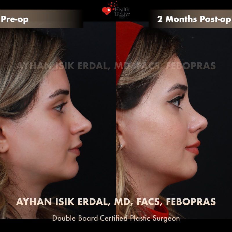 Revision rhinoplasty before and after