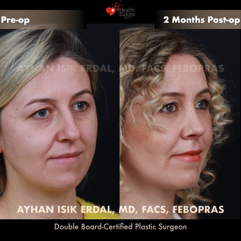 Rhinoplasty before and after - oblique view