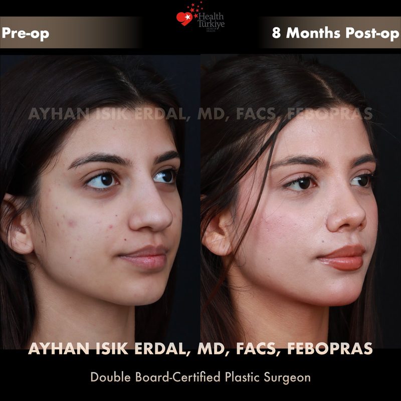 Rhinoplasty before and after - oblique view