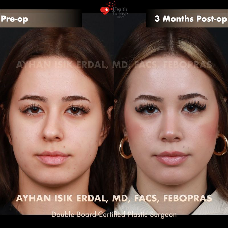 Closed technique nose surgery — female frontal view, 6 months post-op