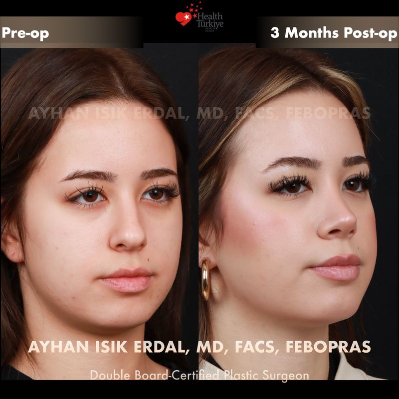 Closed technique nose surgery — female oblique view, 6 months post-op