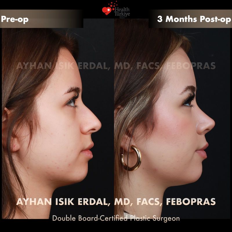 Closed technique nose surgery — female profile view, 6 months post-op