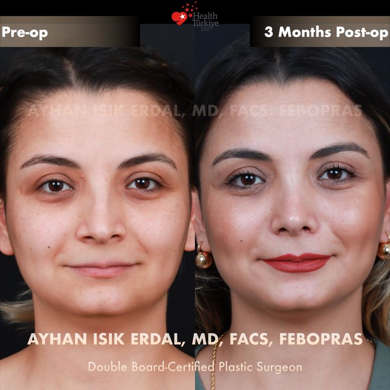 Closed rhinoplasty Istanbul — female patient frontal view, 3 months post-op