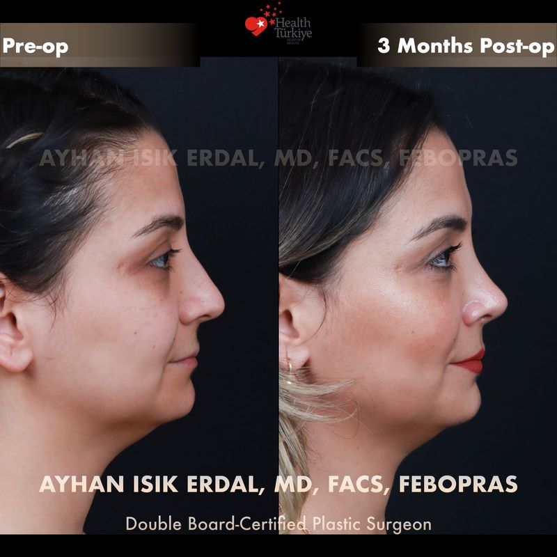 Closed rhinoplasty Istanbul — female patient oblique view, 3 months post-op
