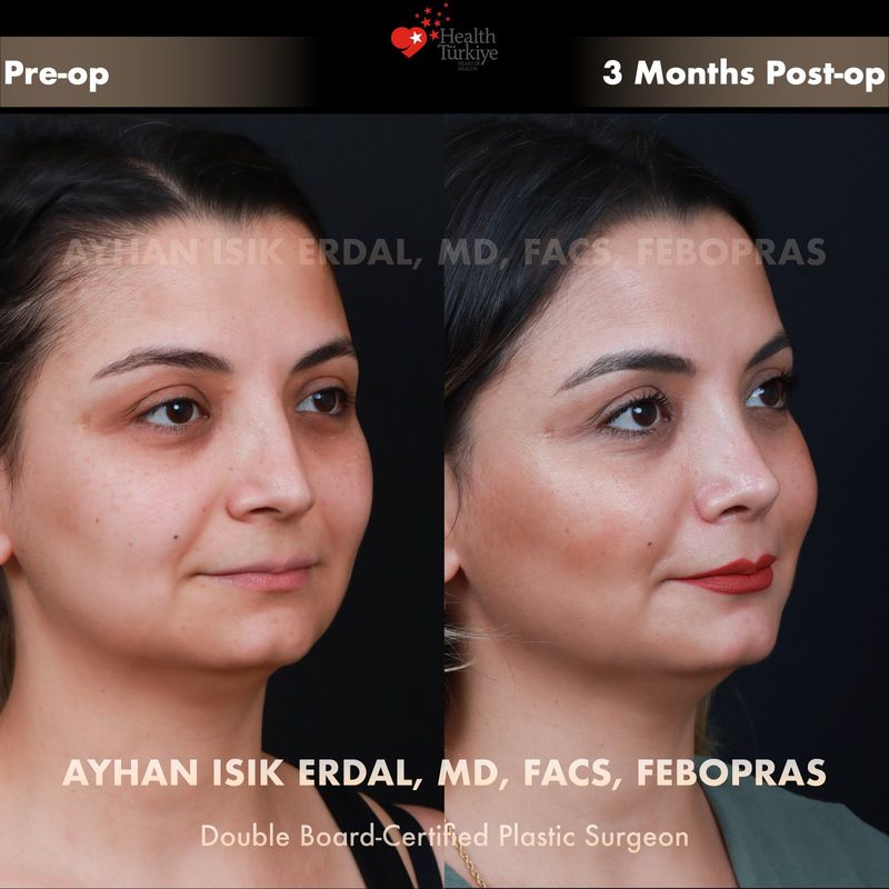 Closed rhinoplasty Istanbul — female patient profile view, 3 months post-op