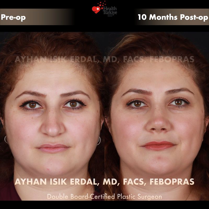 Closed rhinoplasty — female patient frontal view, 9 months post-op
