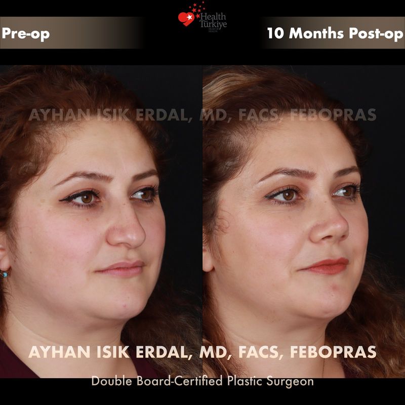 Closed rhinoplasty — female patient oblique view, 9 months post-op