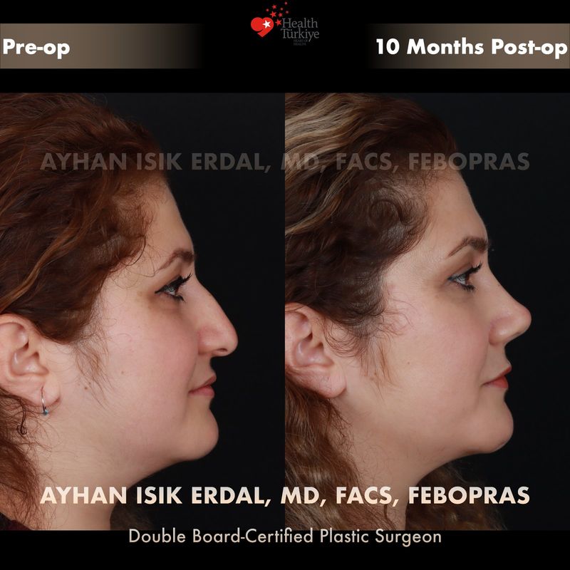 Closed rhinoplasty — female patient profile view, 9 months post-op