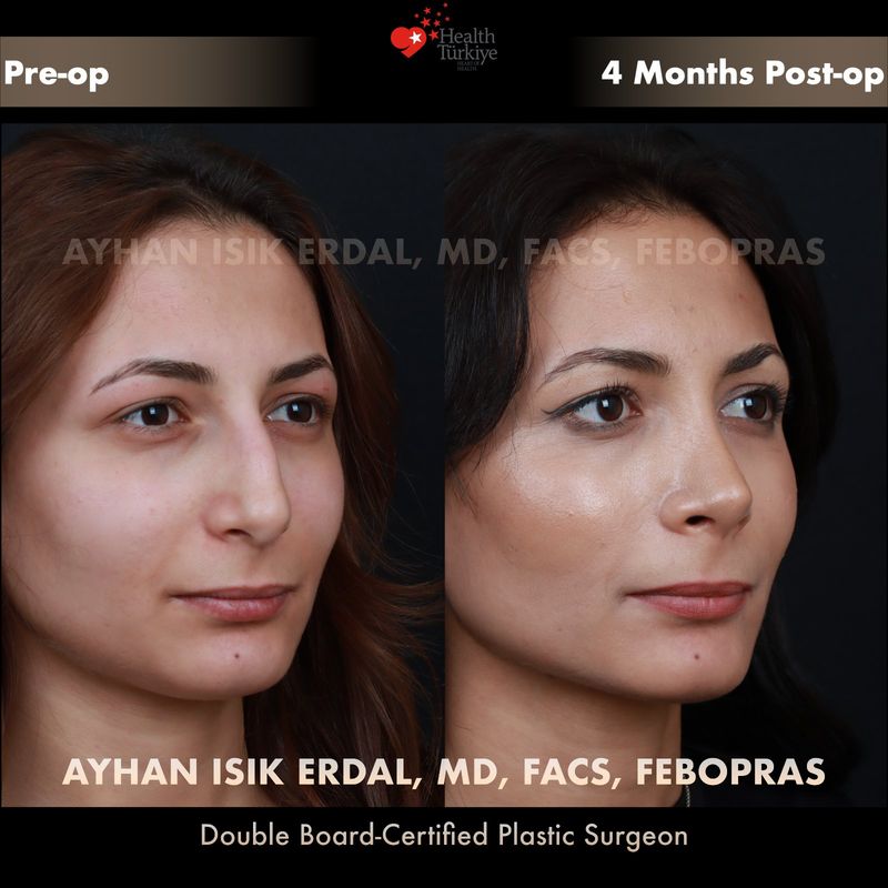Closed rhinoplasty before and after — female patient oblique view, 4 months post-op