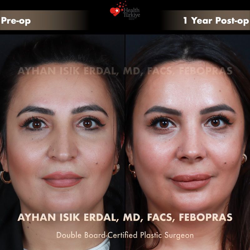 Rhinoplasty Istanbul results — female patient frontal view, 12 months post-op