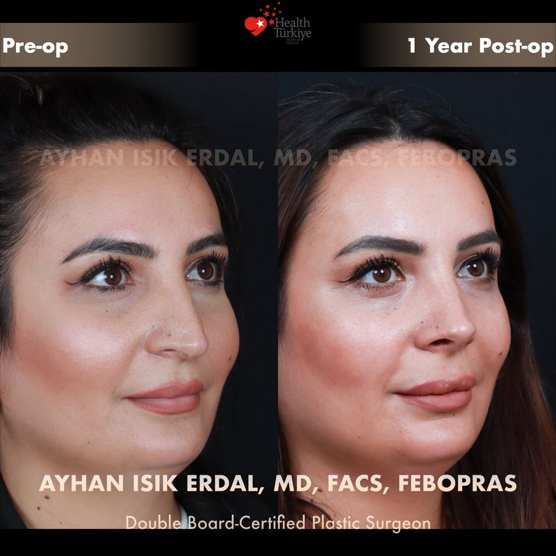 Rhinoplasty Istanbul results — female patient oblique view, 12 months post-op