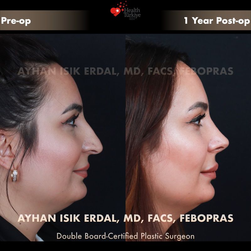Rhinoplasty Istanbul results — female patient profile view, 12 months post-op