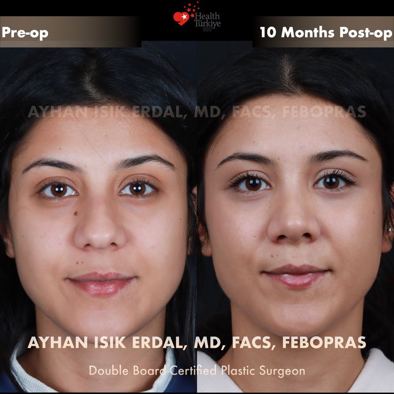 Male closed rhinoplasty — frontal view, 4 months post-op