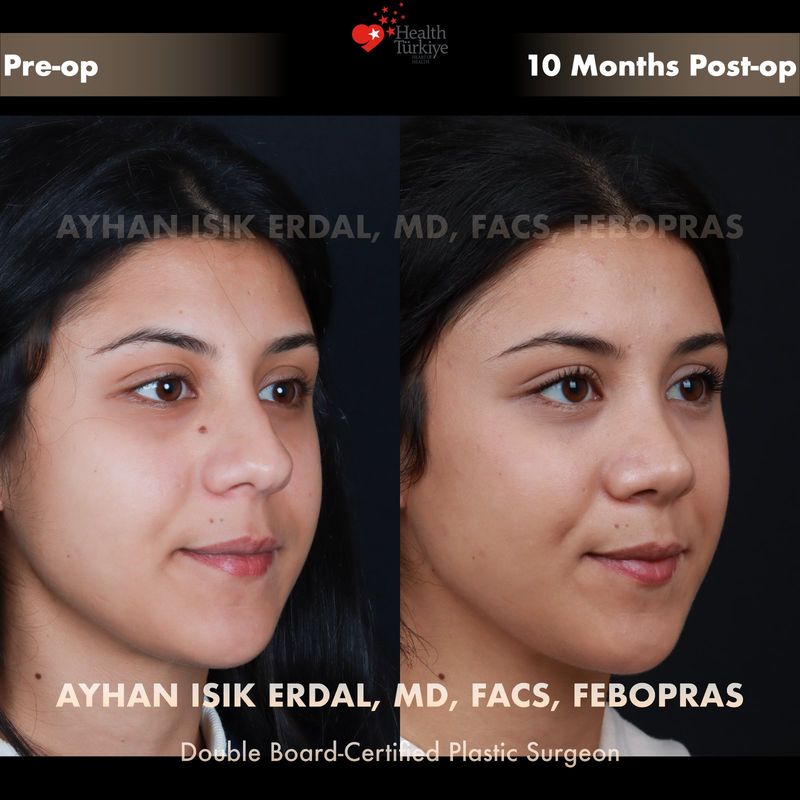 Male closed rhinoplasty — oblique view, 4 months post-op