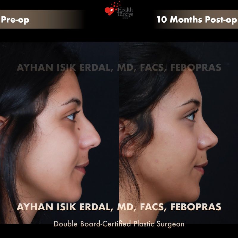 Male closed rhinoplasty — profile view, 4 months post-op