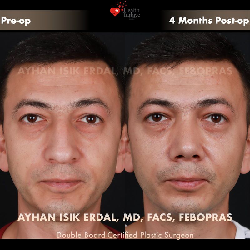 Nose job Istanbul before after — female patient frontal view, 10 months post-op