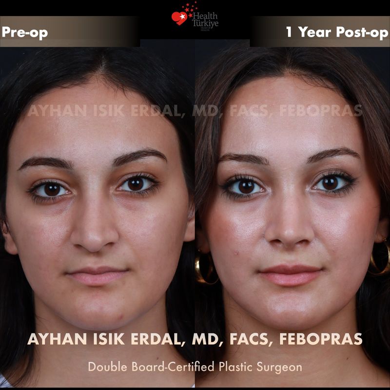 Closed rhinoplasty — female patient frontal view, 1 year post-op