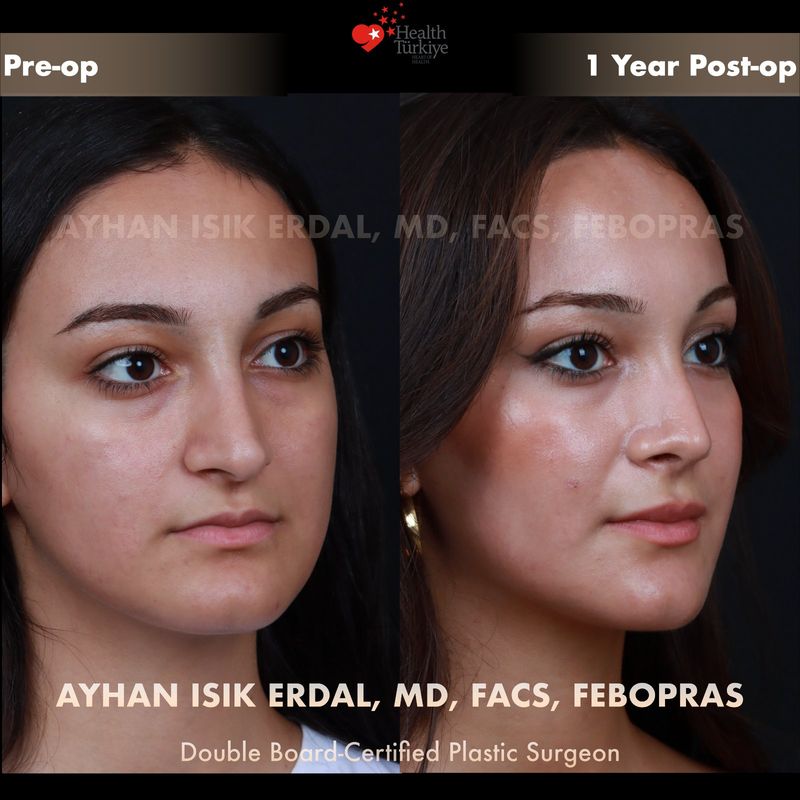 Closed rhinoplasty — female patient oblique view, 1 year post-op