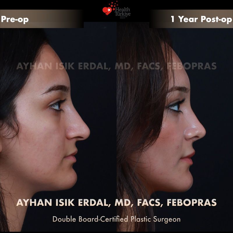 Closed rhinoplasty — female patient profile view, 1 year post-op