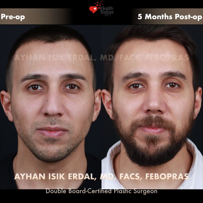 Male closed rhinoplasty Istanbul — frontal view, 5 months post-op