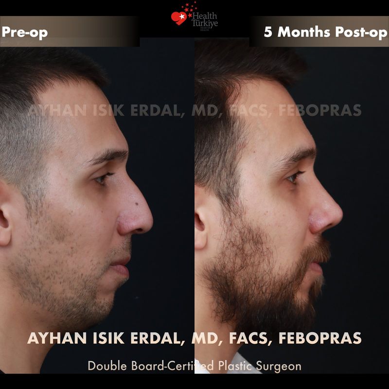 Male closed rhinoplasty Istanbul — oblique view, 5 months post-op
