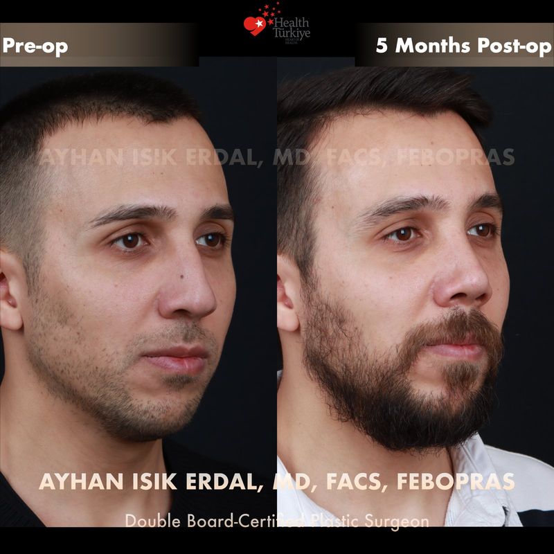 Male closed rhinoplasty Istanbul — profile view, 5 months post-op