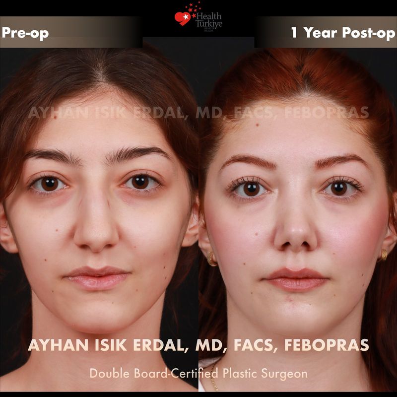 No-scar rhinoplasty result — female frontal view, 1 year post-op