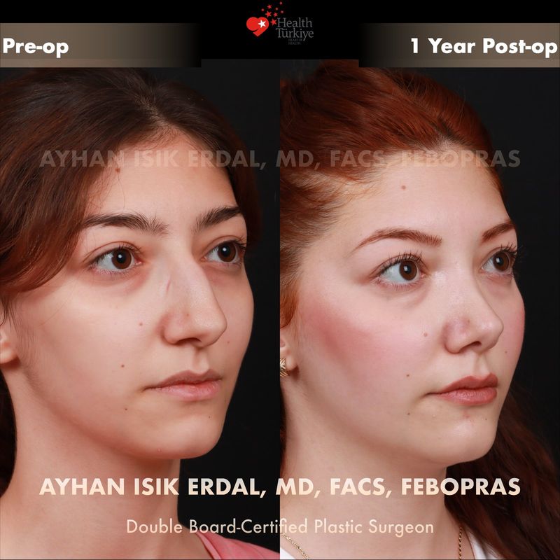 No-scar rhinoplasty result — female oblique view, 1 year post-op