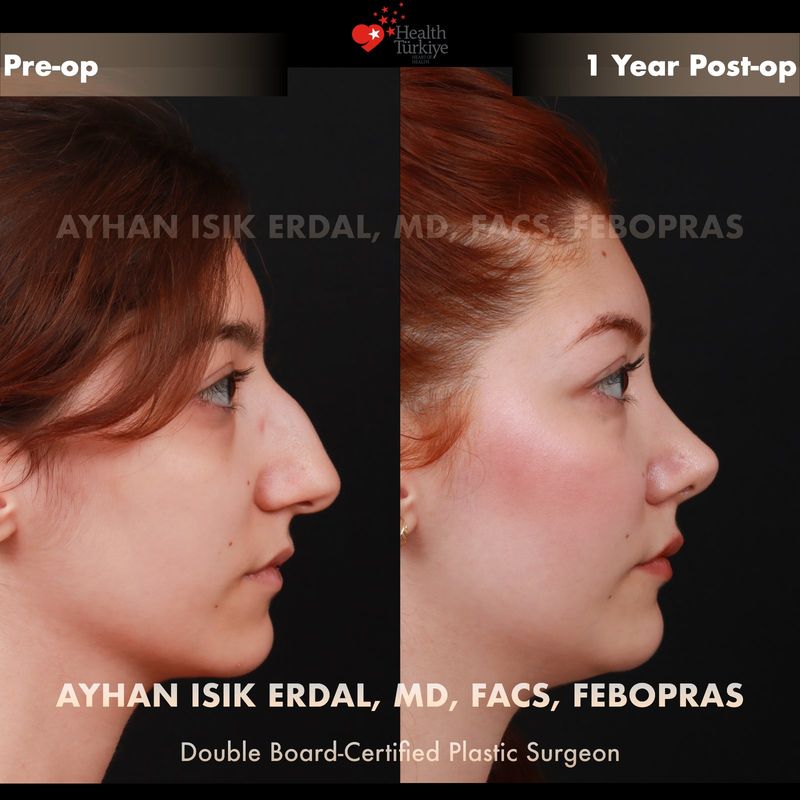 No-scar rhinoplasty result — female profile view, 1 year post-op